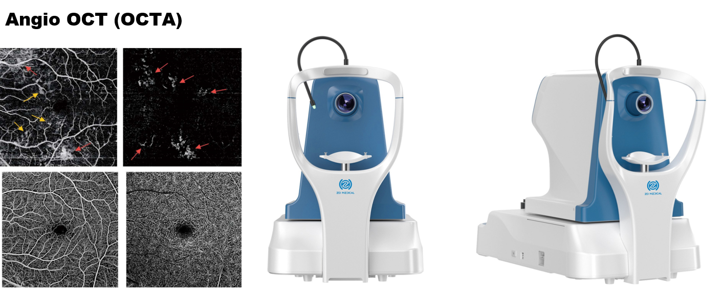 Angio OCT