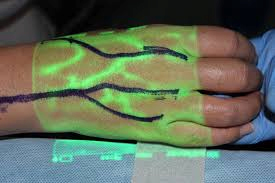 ما هي الأبحاث الأجنبية والتطورات التكنولوجية ذات الصلة بجهاز Vein Finder؟